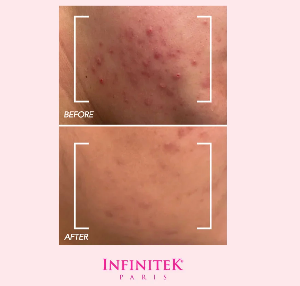 Contains 98% Natural Minerals from Dead Sea Mud that deeply cleanse the skin, removing blackheads, toxins, and excess oil. Ideal for acne-prone or oily skin